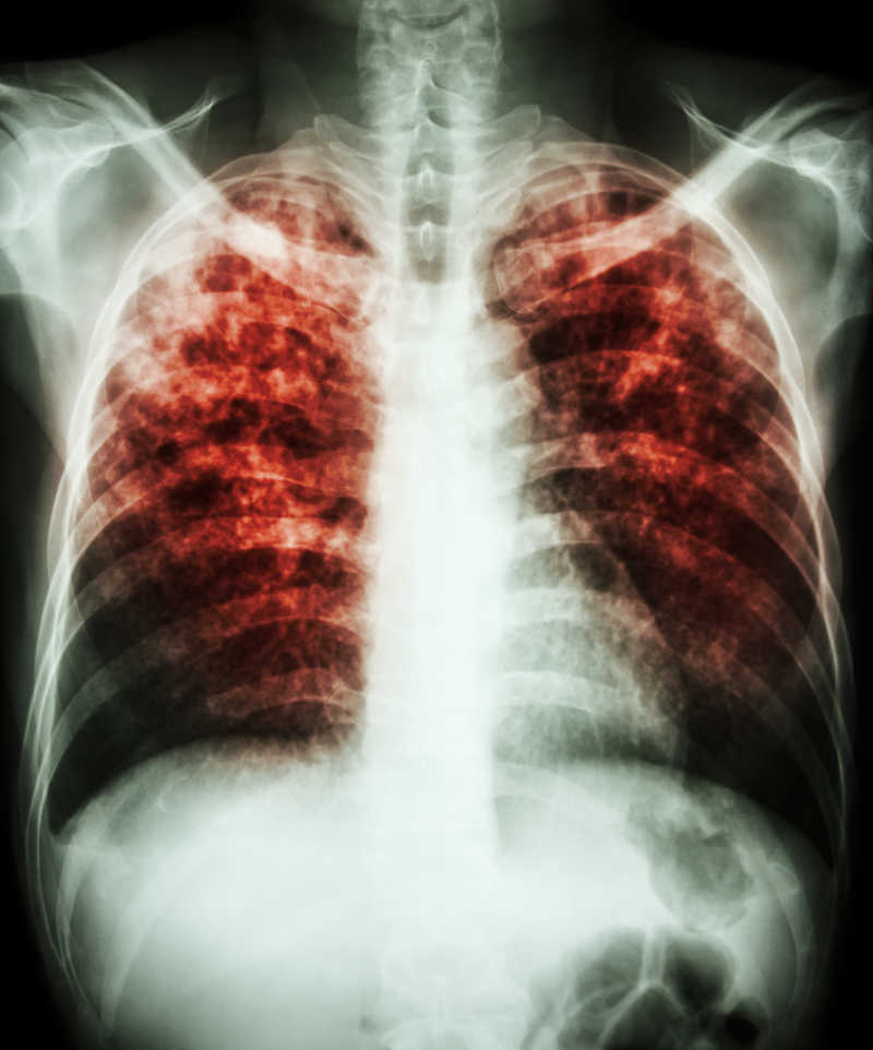 X线胸片显示结核分枝杆菌感染引起的肺间质浸润