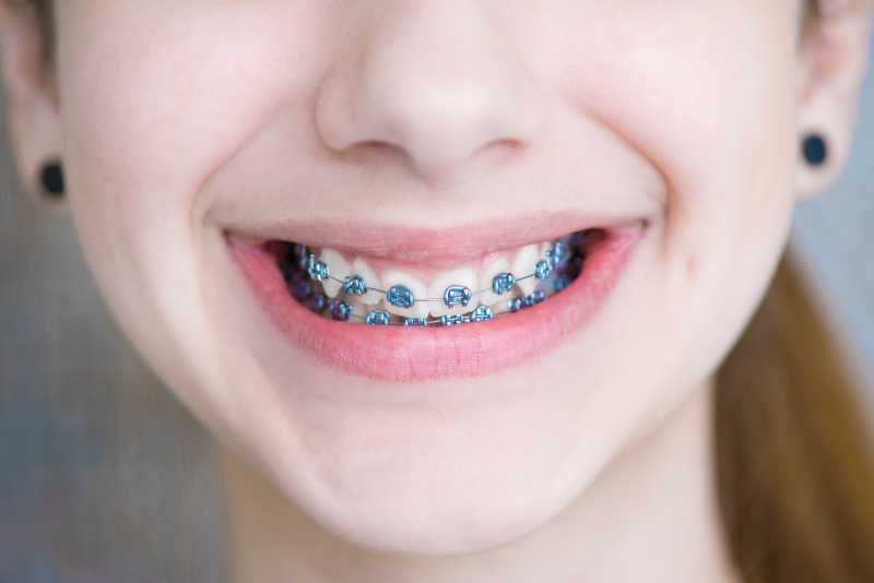 微笑的女孩露出带着牙套的牙齿