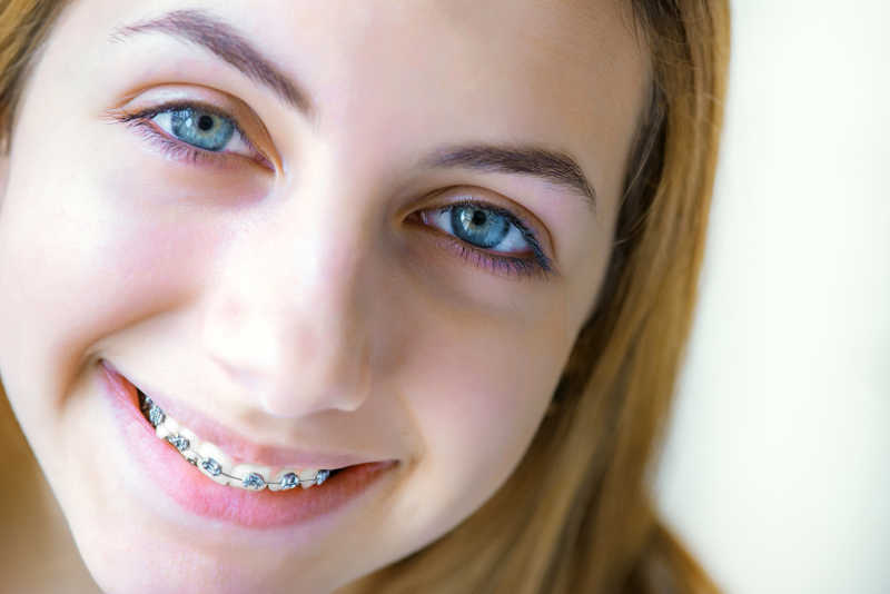 一位年轻的美女带着牙套矫正牙齿