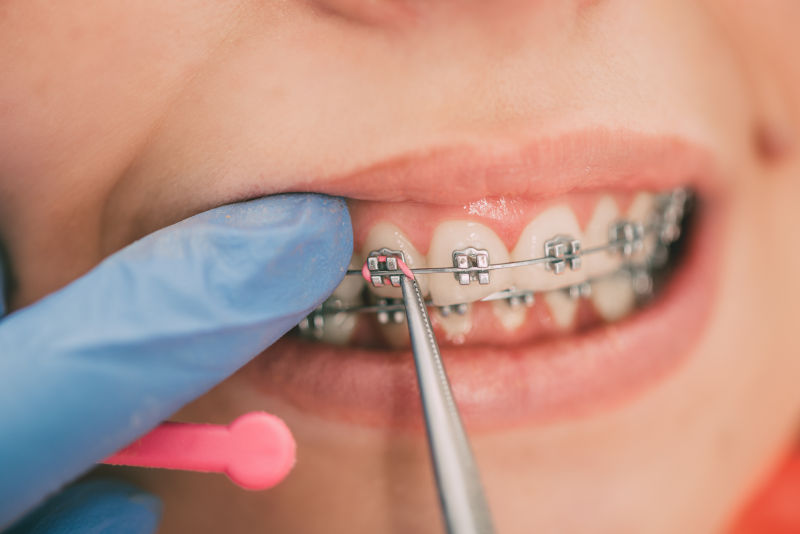 牙医检查女病人牙齿上的支架