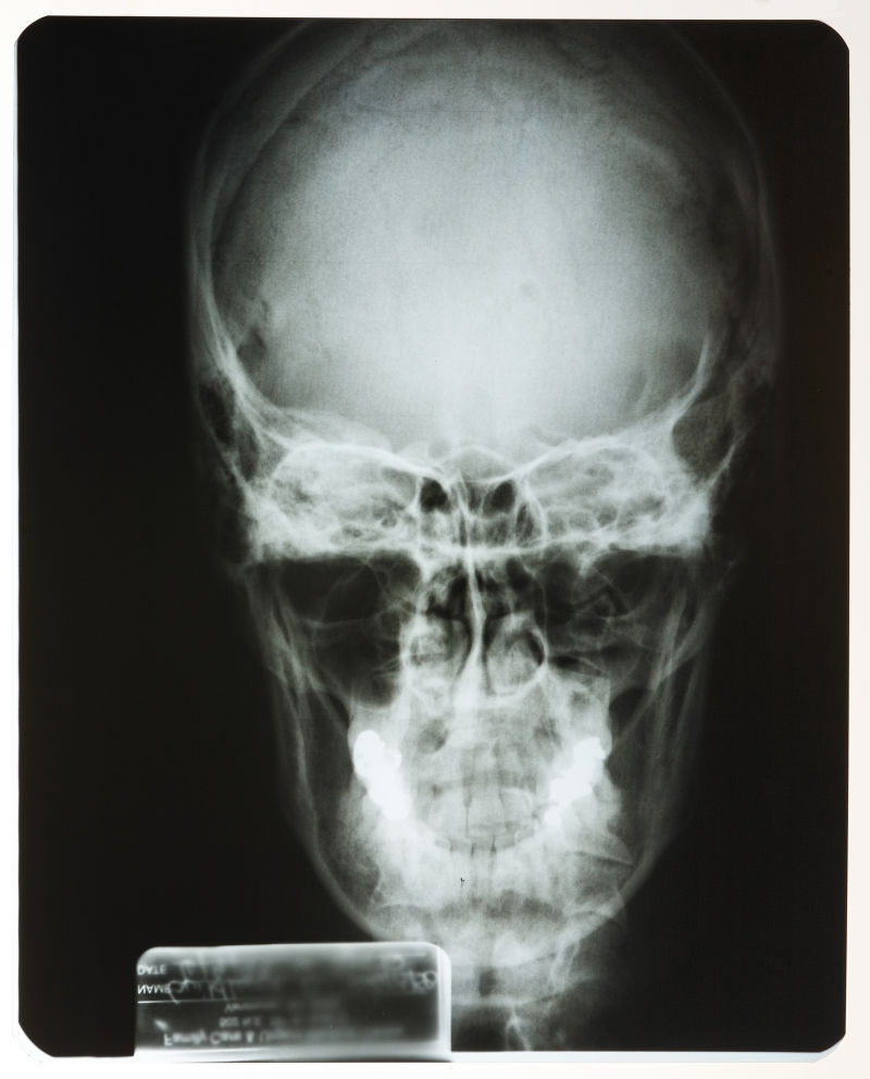 颅骨骨骼部位x射线片子