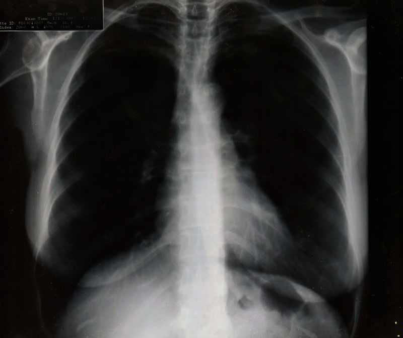 胸透肺部的x射线片子