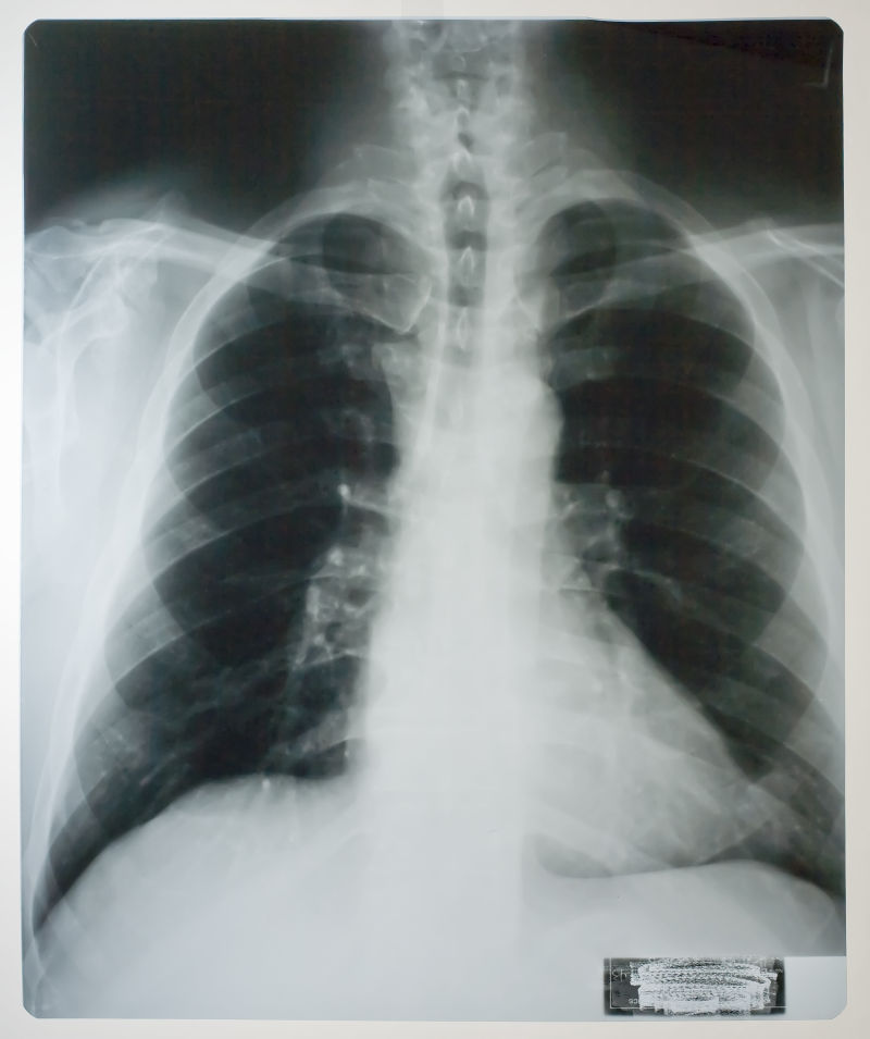 人体肺部x射线片子