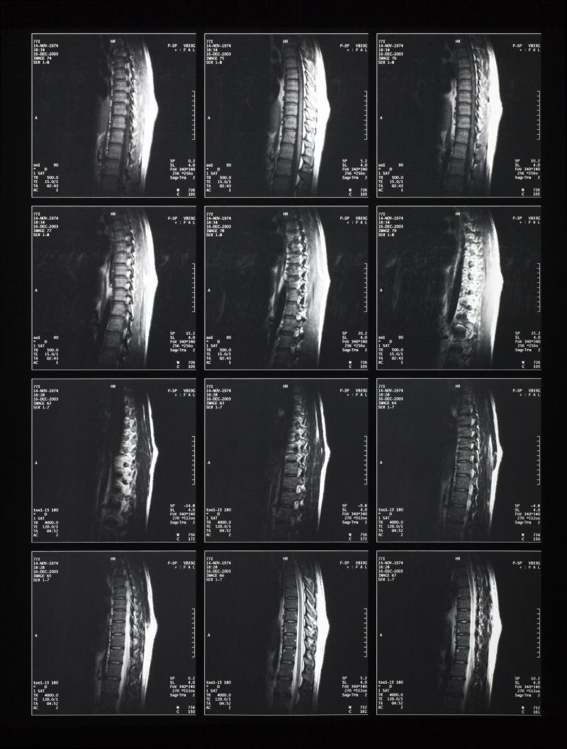 人体脊椎关节x射线片子