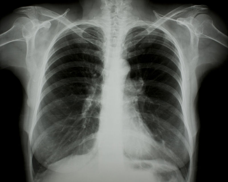 肺部骨骼x射线片子