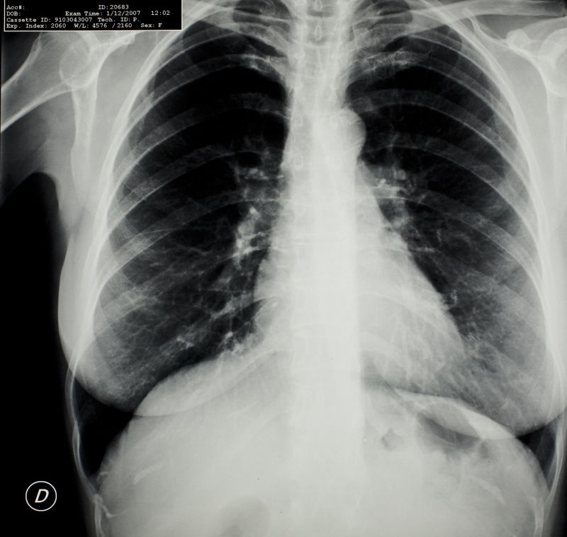 肺部胸透x射线片子
