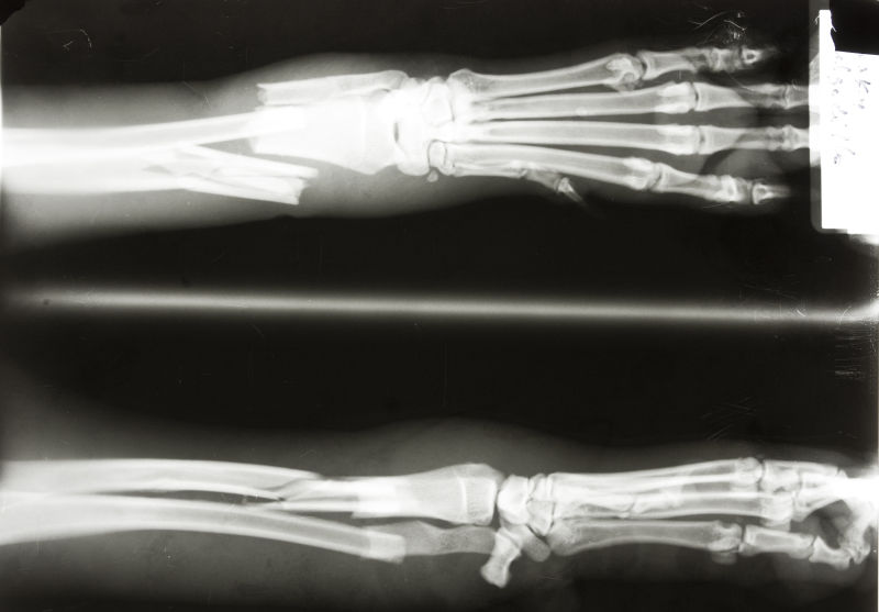 断裂的手臂骨骼x射线片子