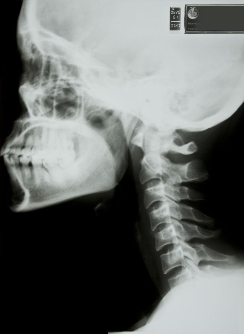 人体颈椎x射线片子