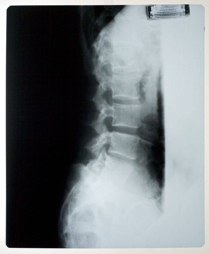 脊椎关节x射线片子