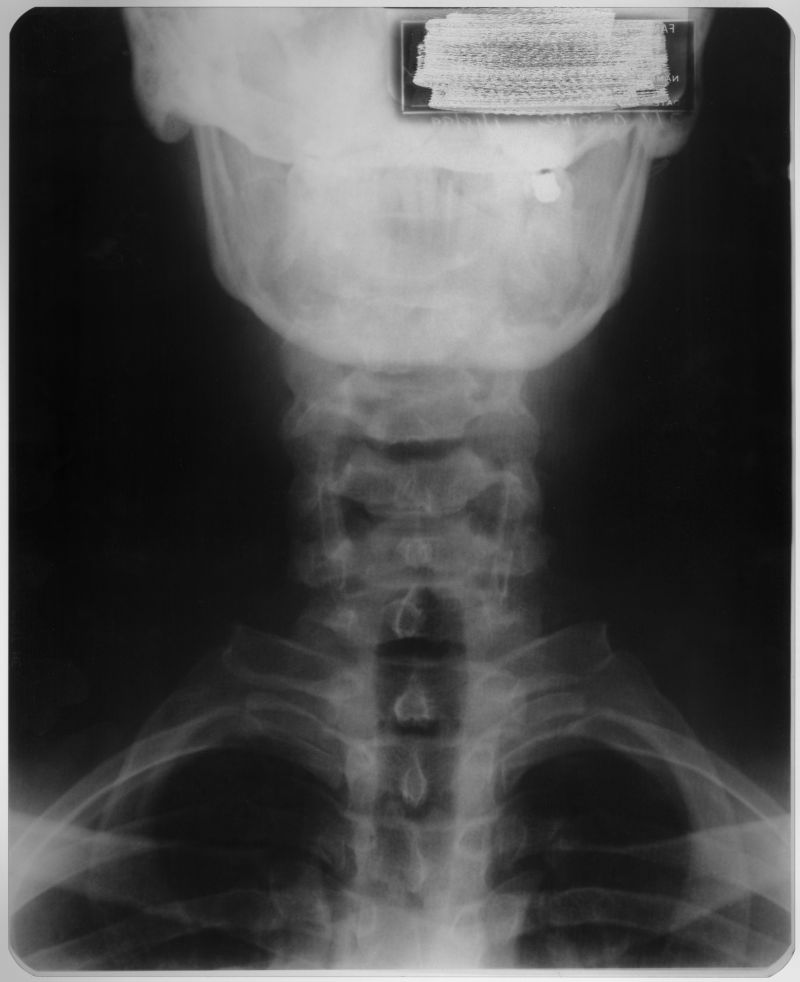 人体颈部x射线片子