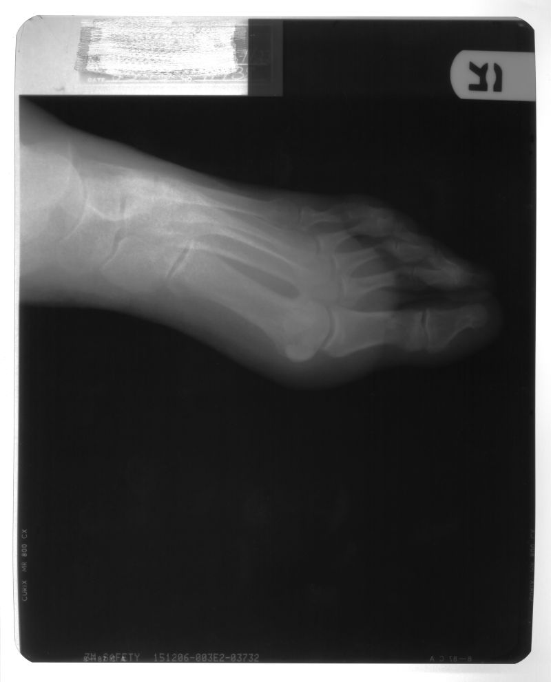 脚掌的骨骼x射线片子
