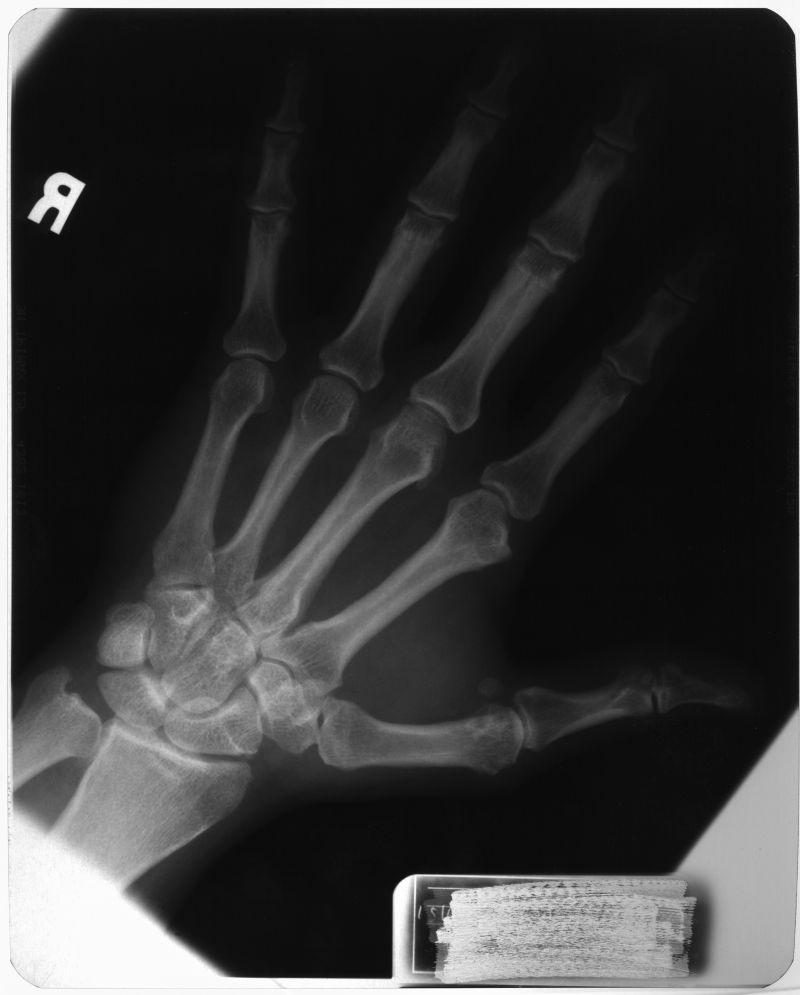 手指骨骼CTx射线片子