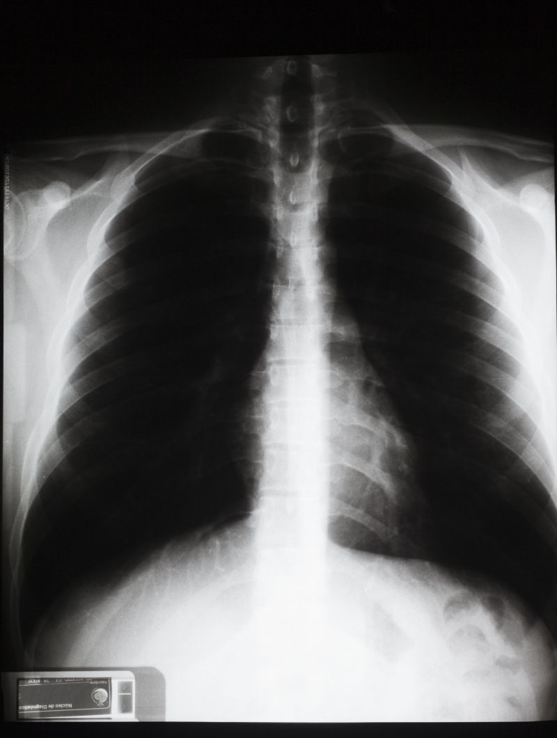 人体胸部x射线片子