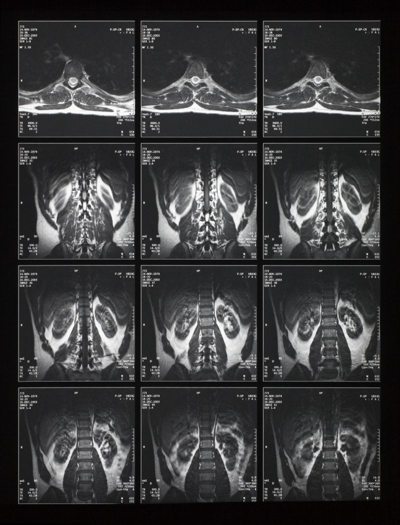 腰部脊椎x射线片子