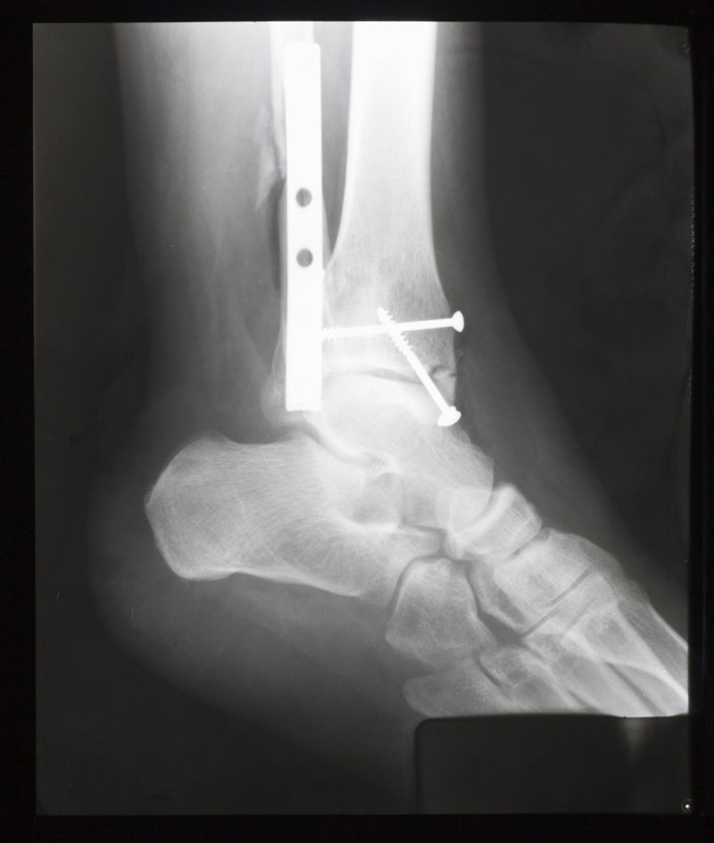 打着钢钉的脚踝骨骼x射线片子
