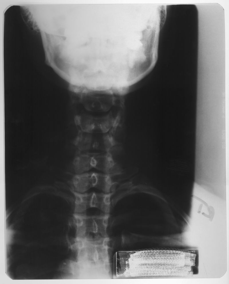 颈椎关节x射线片子