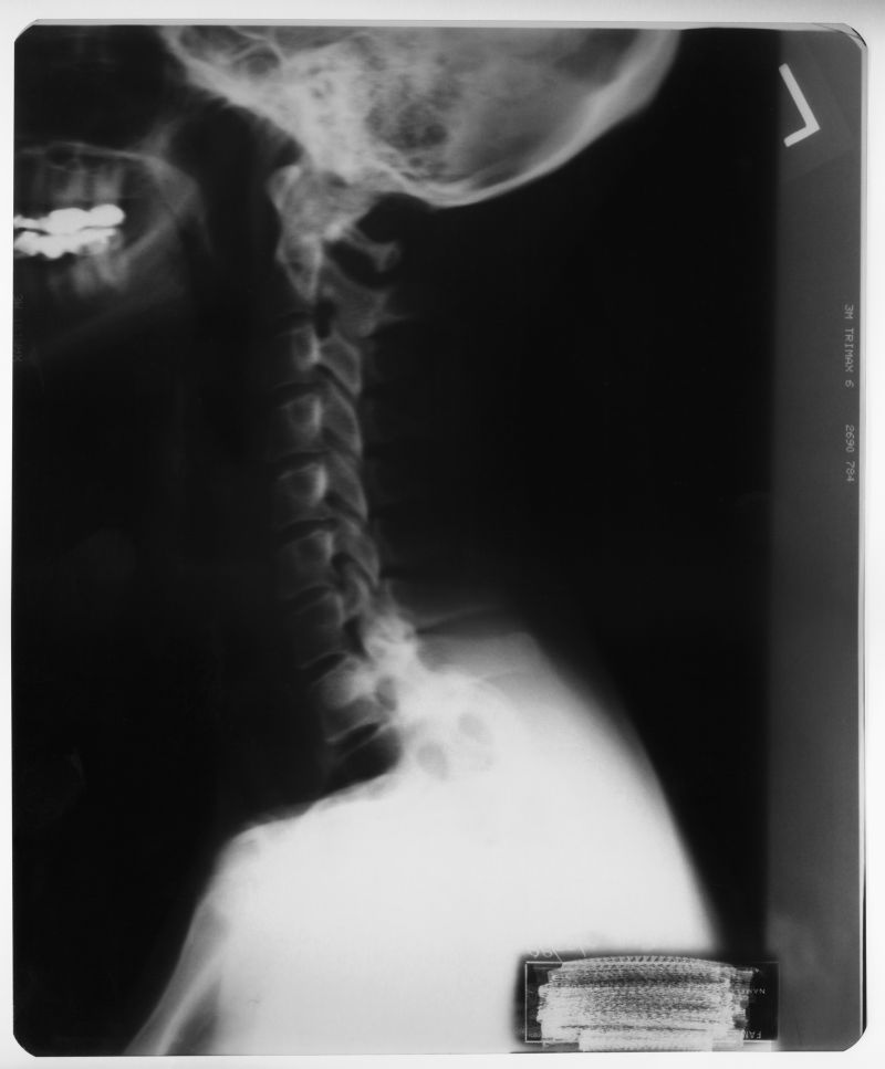 颈椎部位x射线片子
