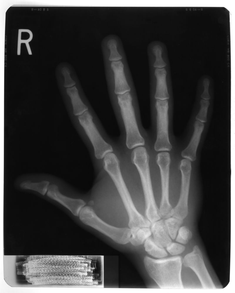 手指骨骼部位x射线片子