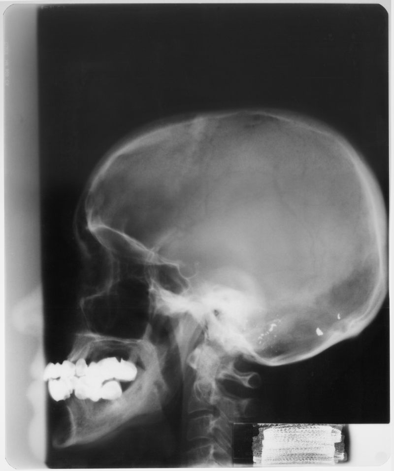 颅骨的x射线片子
