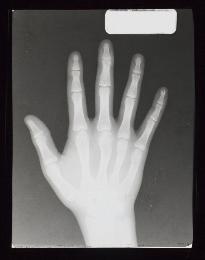 人体手掌的x射线片子