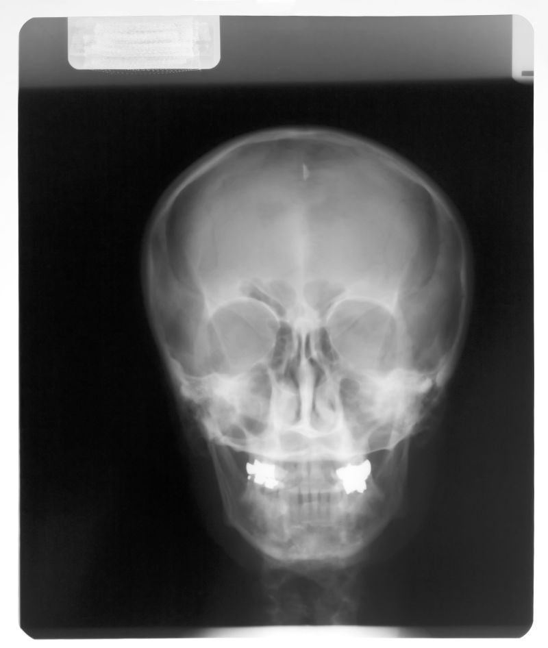 人体头颅骨骼x射线片子