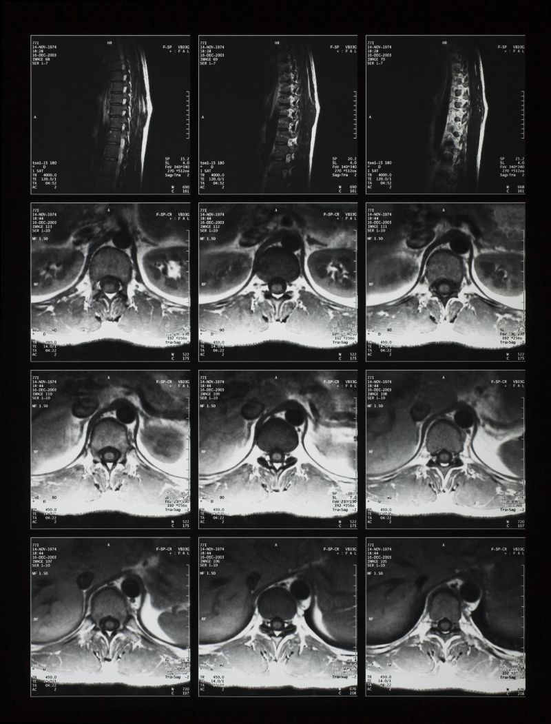 侧面脊椎x射线片子
