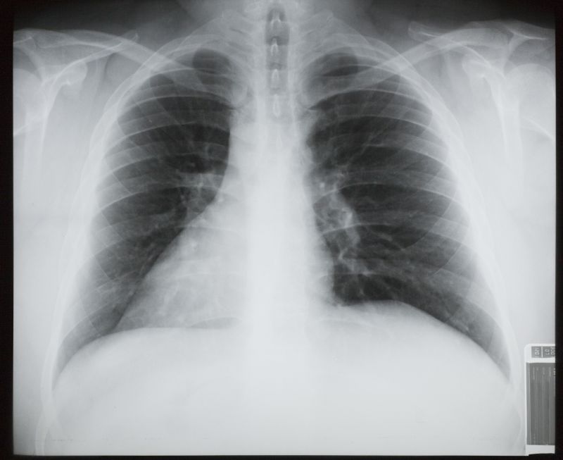 肋骨肺部x射线片子
