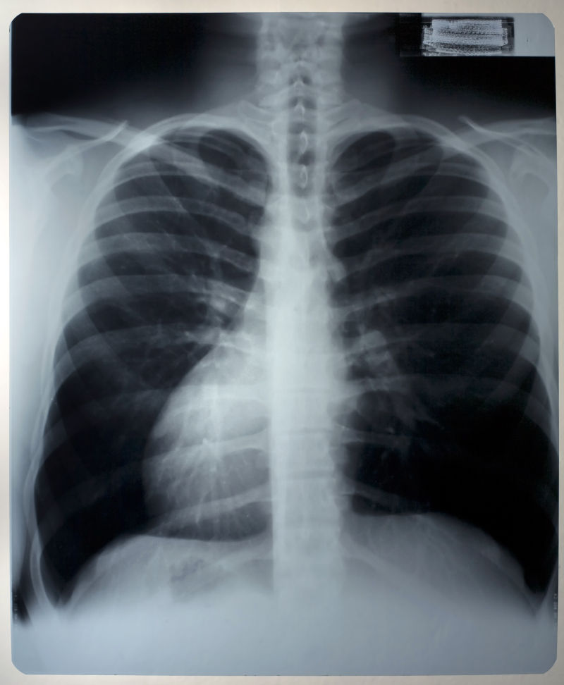 身体肺部x射线片子