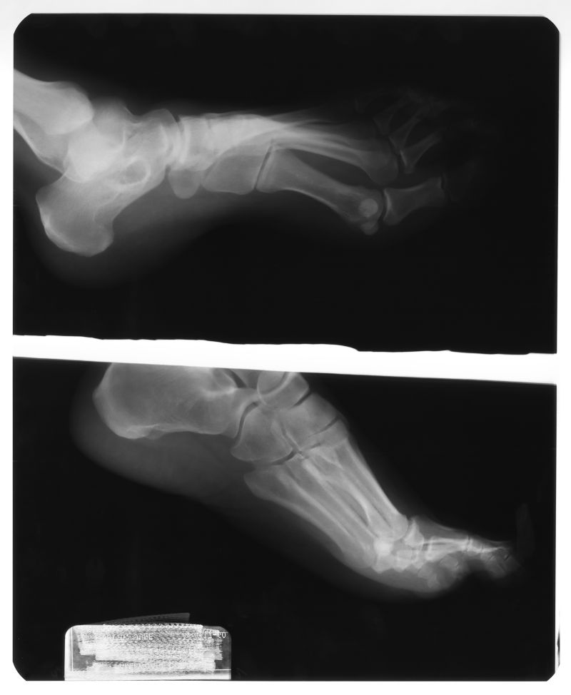 人体的脚骨骨骼x射线片子