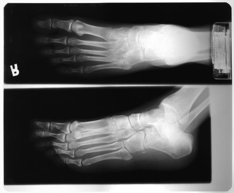 人体脚掌骨骼x射线片子