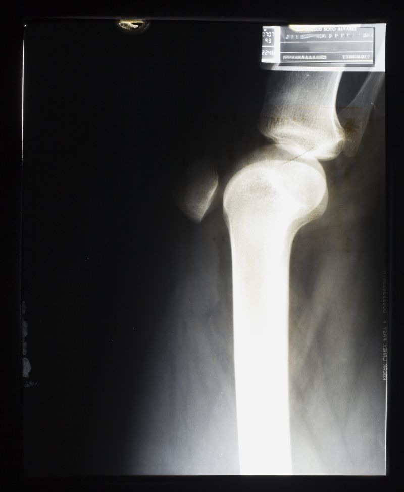 骨骼关节x射线片子