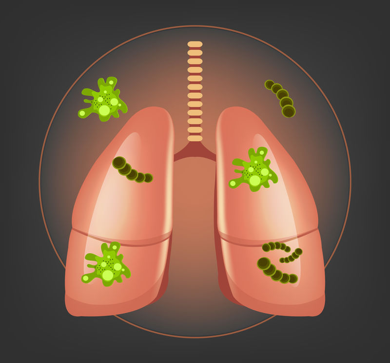 有细菌和细菌的肺-矢量图示