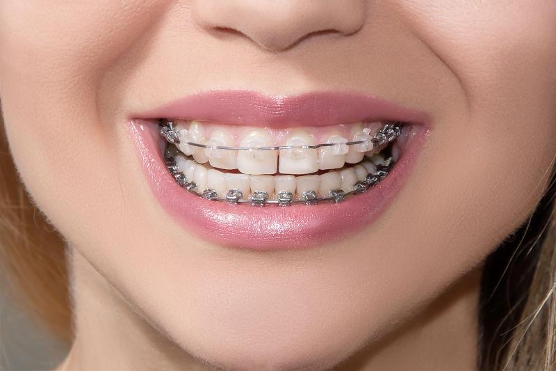 美女带着牙套的牙齿